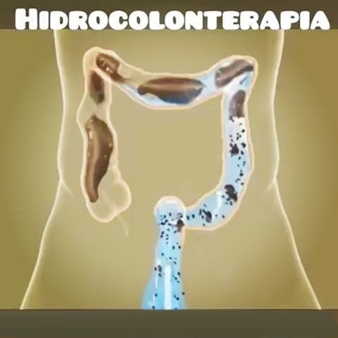 hidrocolonterapia